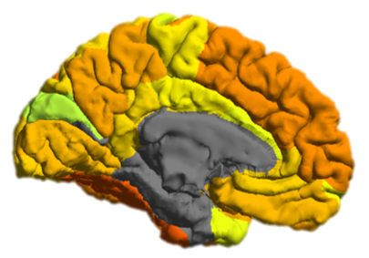 File:BipolarDisorder medial.png